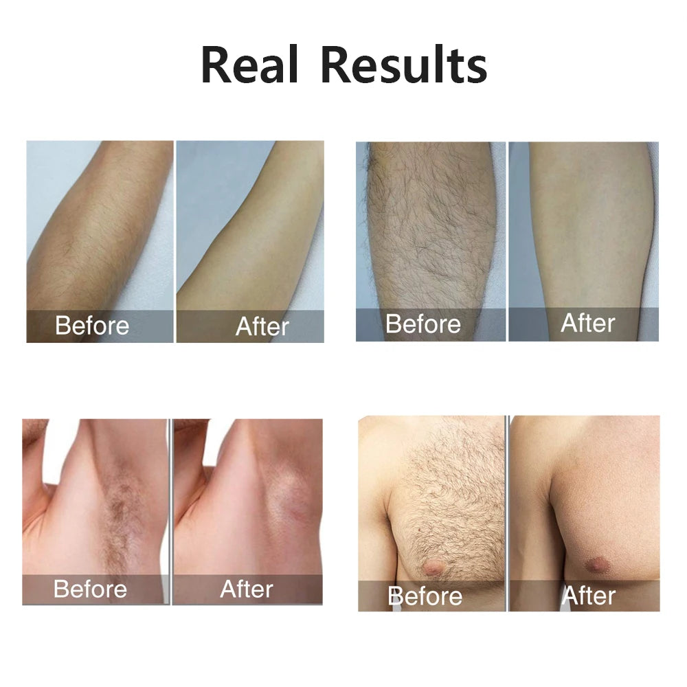 Épilateur laser IPL pour femme – épilation du corps, bikini et visage, 990 000 flashs, épilation permanente et indolore.