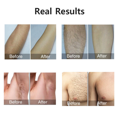 Épilateur laser IPL pour femme – épilation du corps, bikini et visage, 990 000 flashs, épilation permanente et indolore.